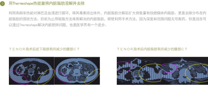 thermoshape֬ܽⲢȥ